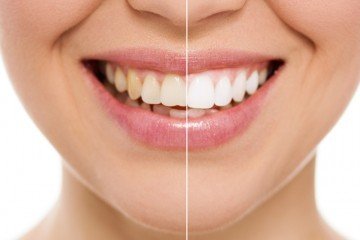dental veneers