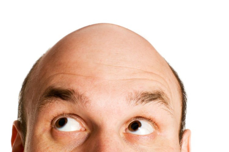 baldness | Longevity LIVE
