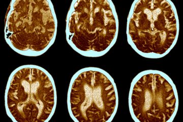 Multiple Sclerosis| Longevity LIVE