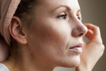 acne | Longevity Live