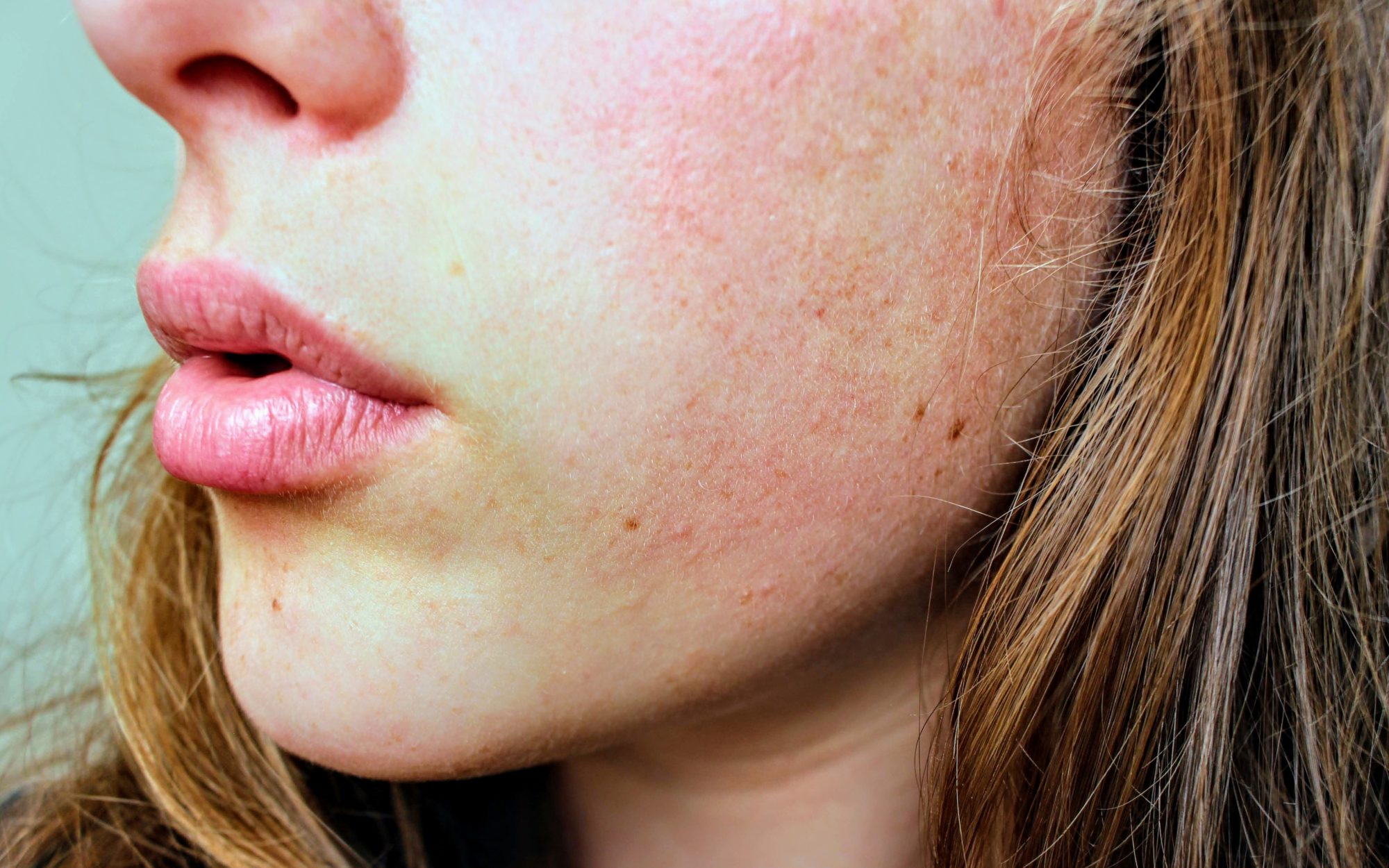 Corona Face Masks And Acne: Here's What You Can Do